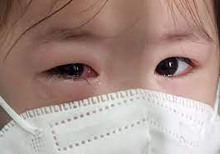 Huyện Châu Thành ghi nhận 959 trường hợp đau mắt đỏ 